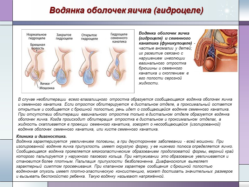 Водянка оболочек яичка (гидроцеле) В случае необлитерации всего влагалищного отростка образуется сообщающаяся водянка оболочек